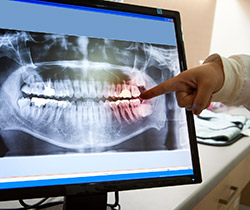 digital dental x-rays